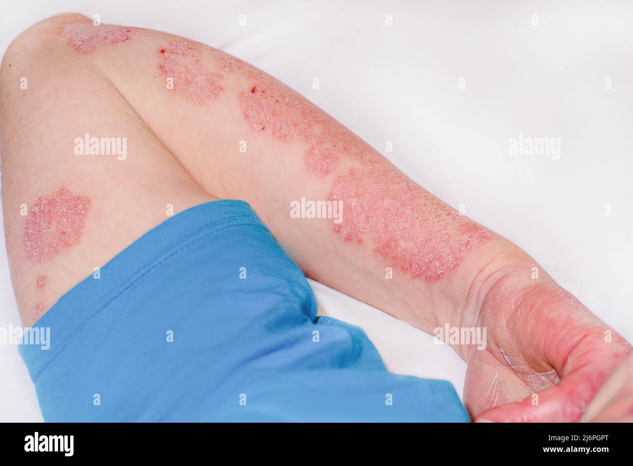 Akute Psoriasis am Arm eines Mannes, starke Rötung der Haut, eine autoimmune, unheilbare