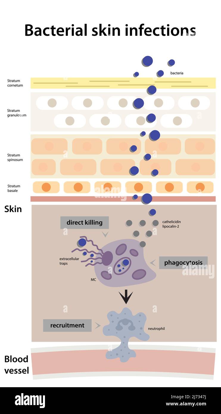 Sheme der bakteriellen Haut-Infektion Entwicklung. Schematische Visualisierung der Phagozytose, Rekrutierung mit Neutrophil Stock Vektor