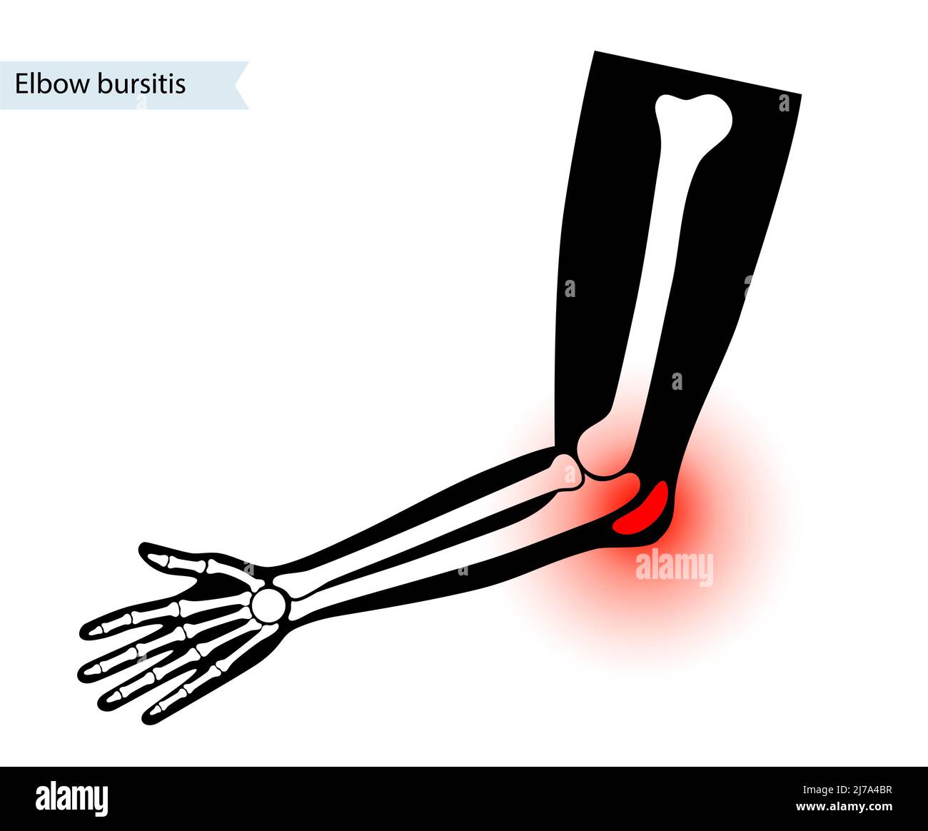 Ellenbogenbursitis, Abbildung Stockfoto