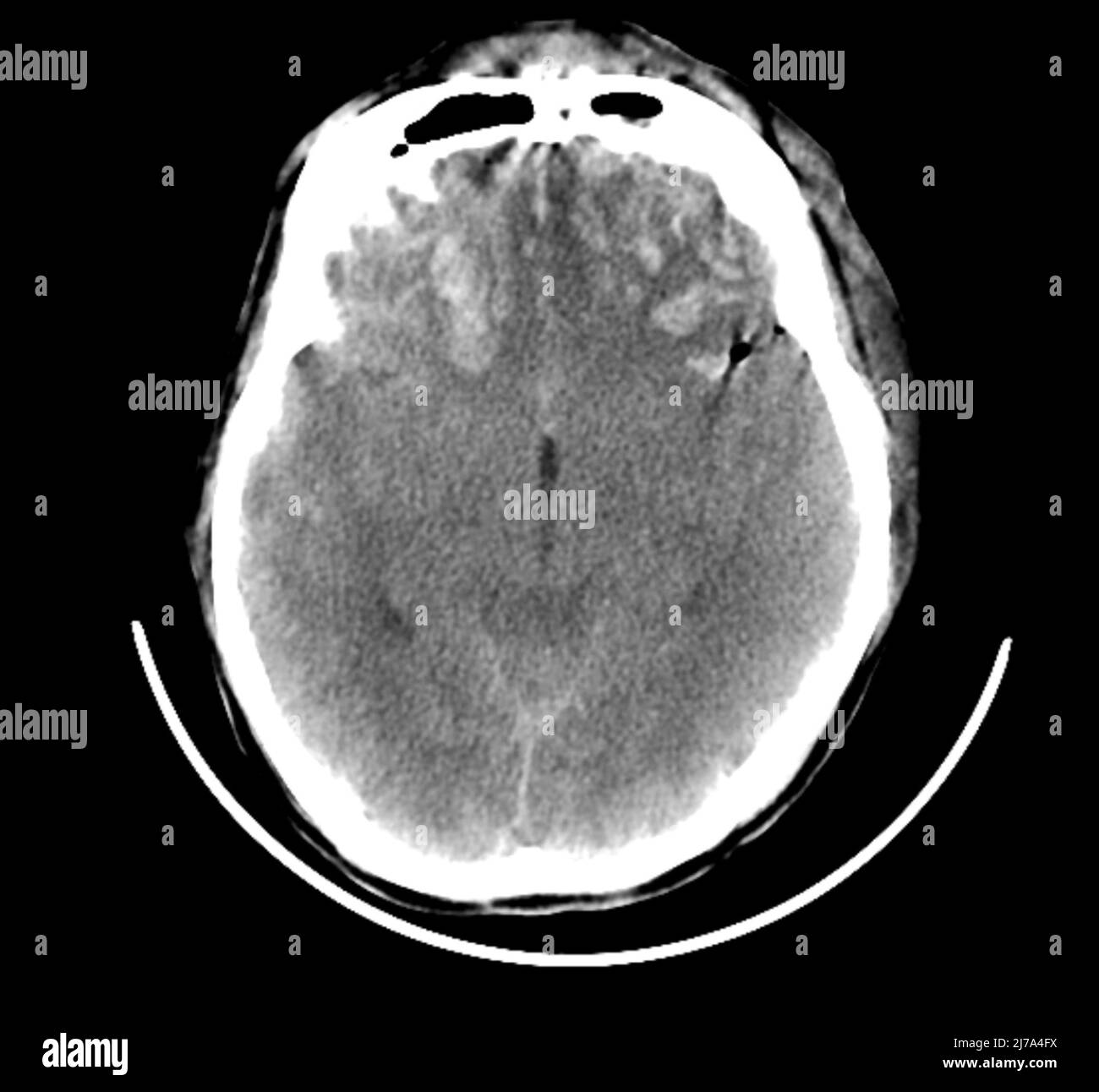 Traumatische Hirnverletzungen, CT-Scan Stockfoto