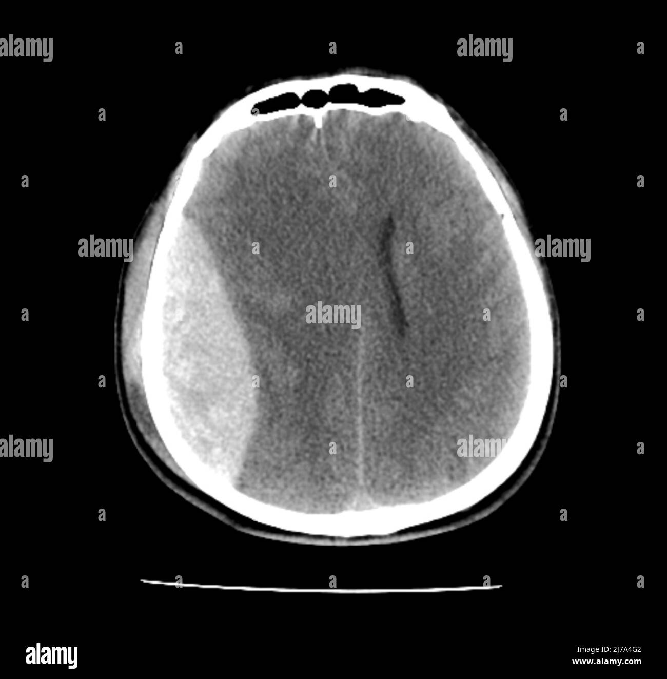 Traumatische Hirnverletzungen, CT-Scan Stockfoto