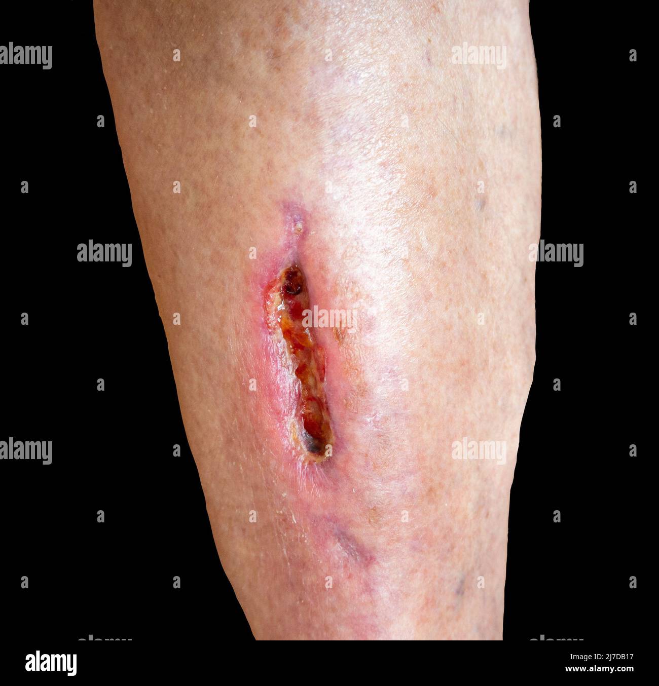 Tief klaffende Wunde am Geliebten-Bein während der medizinischen Behandlung nach schwerer Verletzung. Hautmangel. Isoliert auf Schwarz Stockfoto