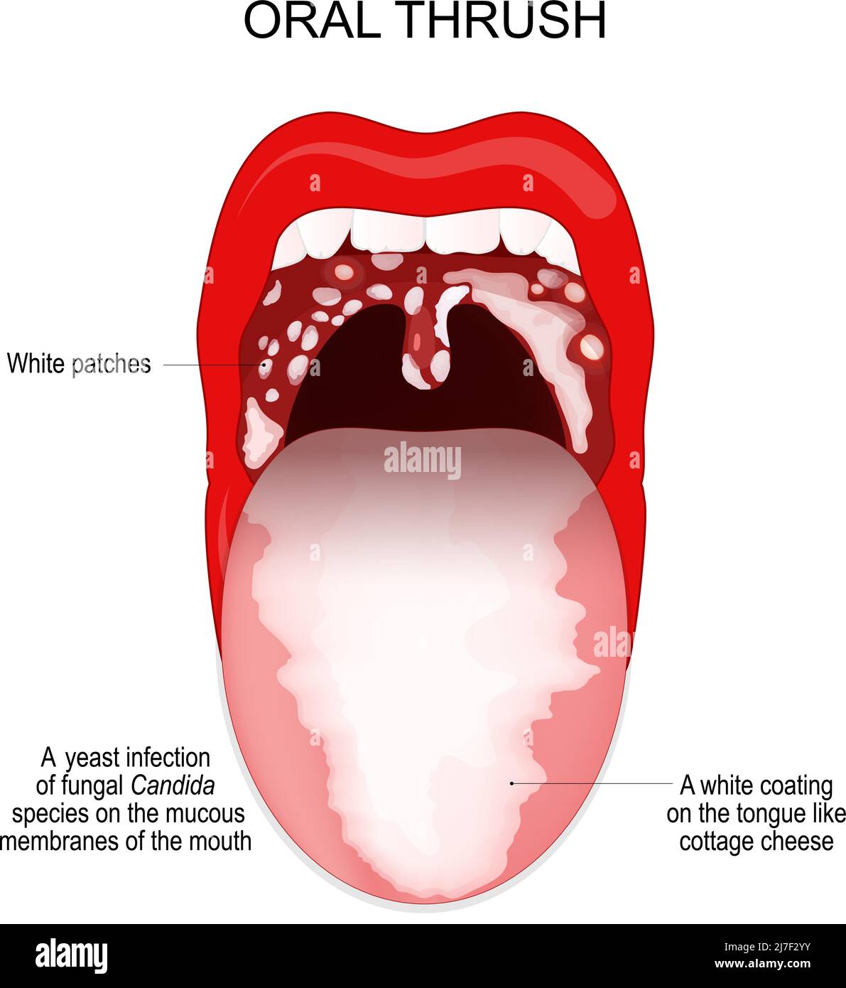 Mundsoor. Eine Hefeinfektion von Pilzarten der Candida-Art an den Mundschleimhäuten. Eine weiße Beschichtung auf der Zunge wie Hüttenkäse. Stock Vektor