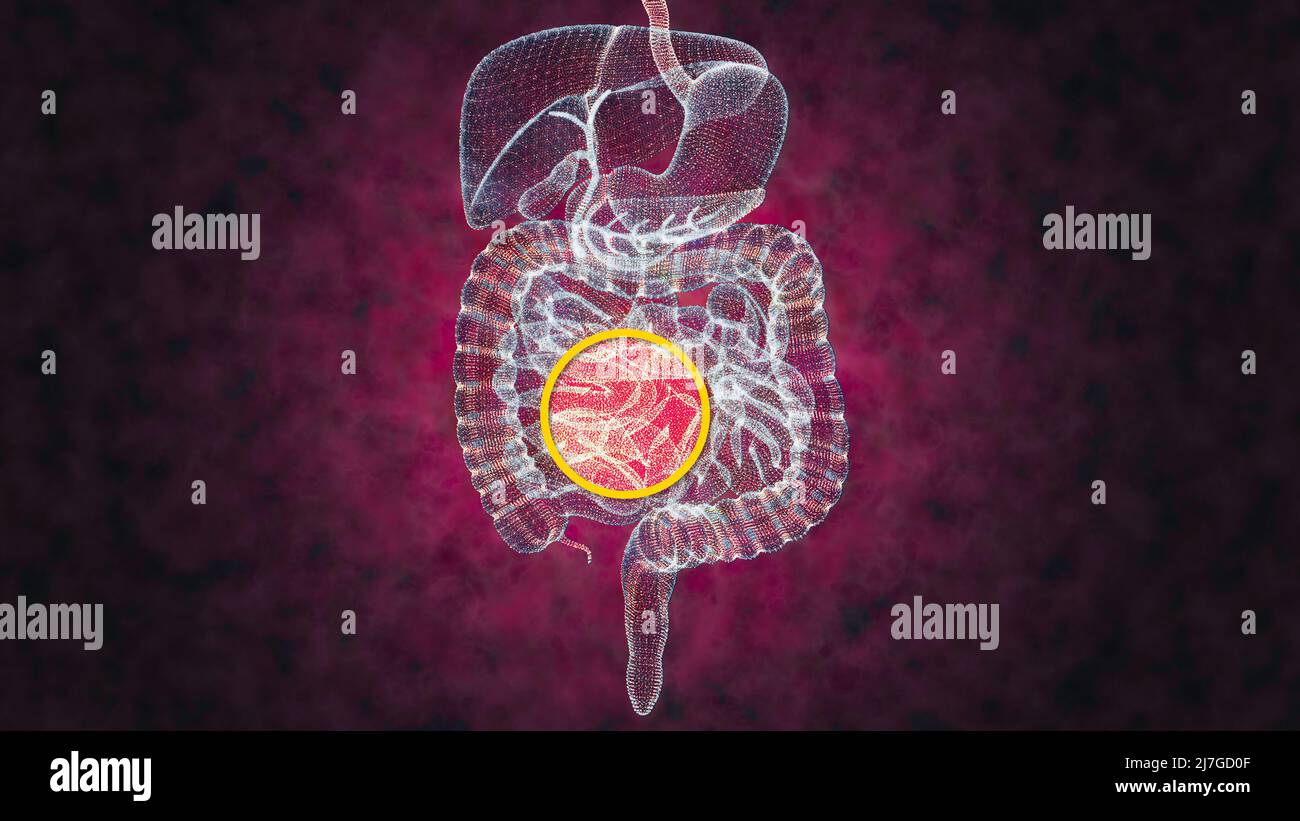 Menschlicher Körper, Verdauungssystem, Anatomie. Darm. Erweiterung im Bauchbereich. Bauchschmerzen. 3D Rendern Stockfoto