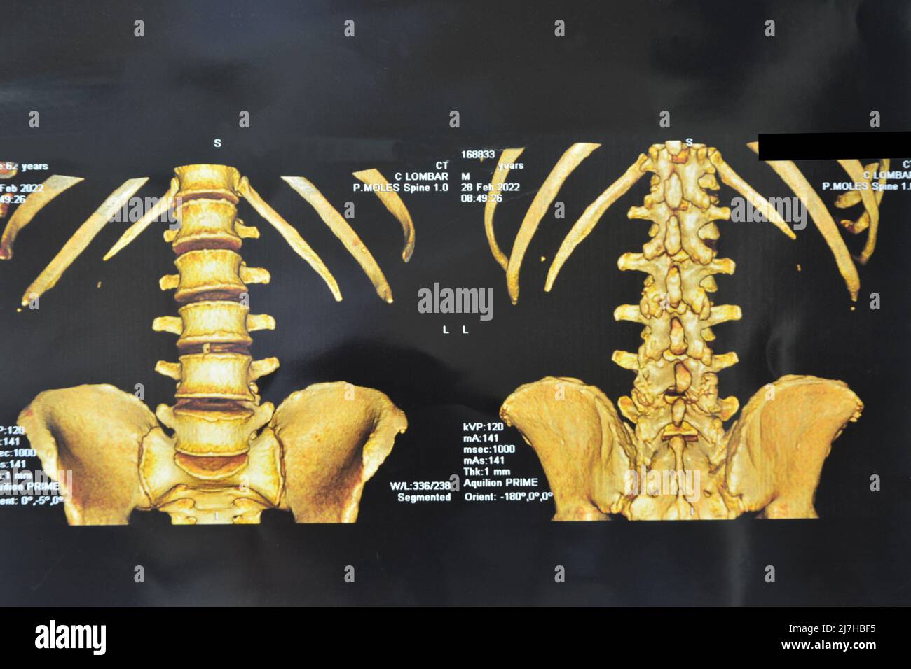 Computertomographie. Älterer Mann mit Rückenproblemen, CT-Scan der Lendenwirbelsäule, lumbosciatische Schmerzen, Brasilien, Südamerika Stockfoto