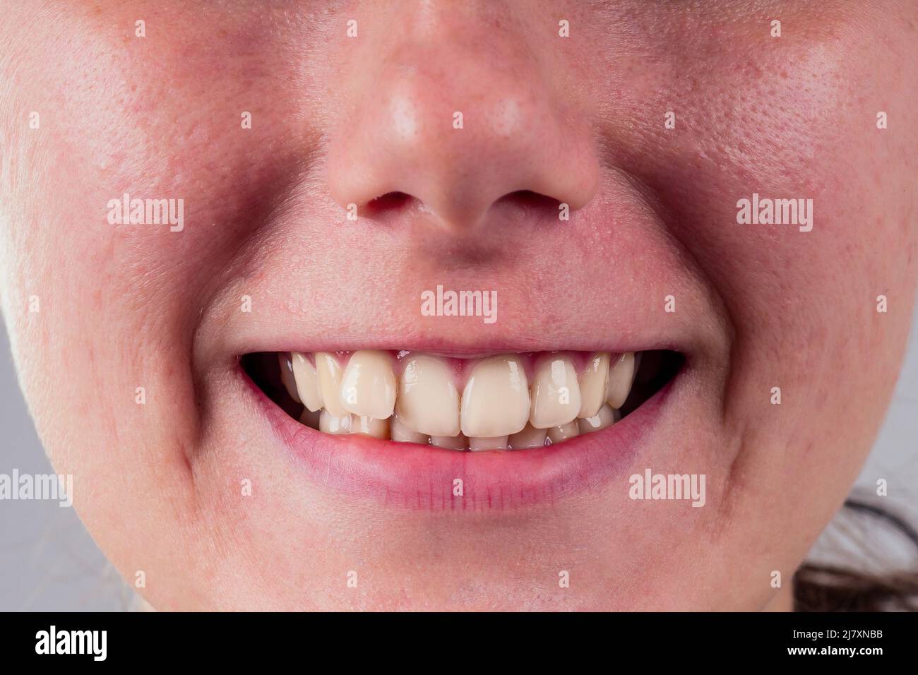 Weißes Lächeln mit Kurv Zahn der jungen Frau auf weißem Hintergrund im Studio .Treatment Zahnspange-System im Büro des Kieferorthopäden Stockfoto