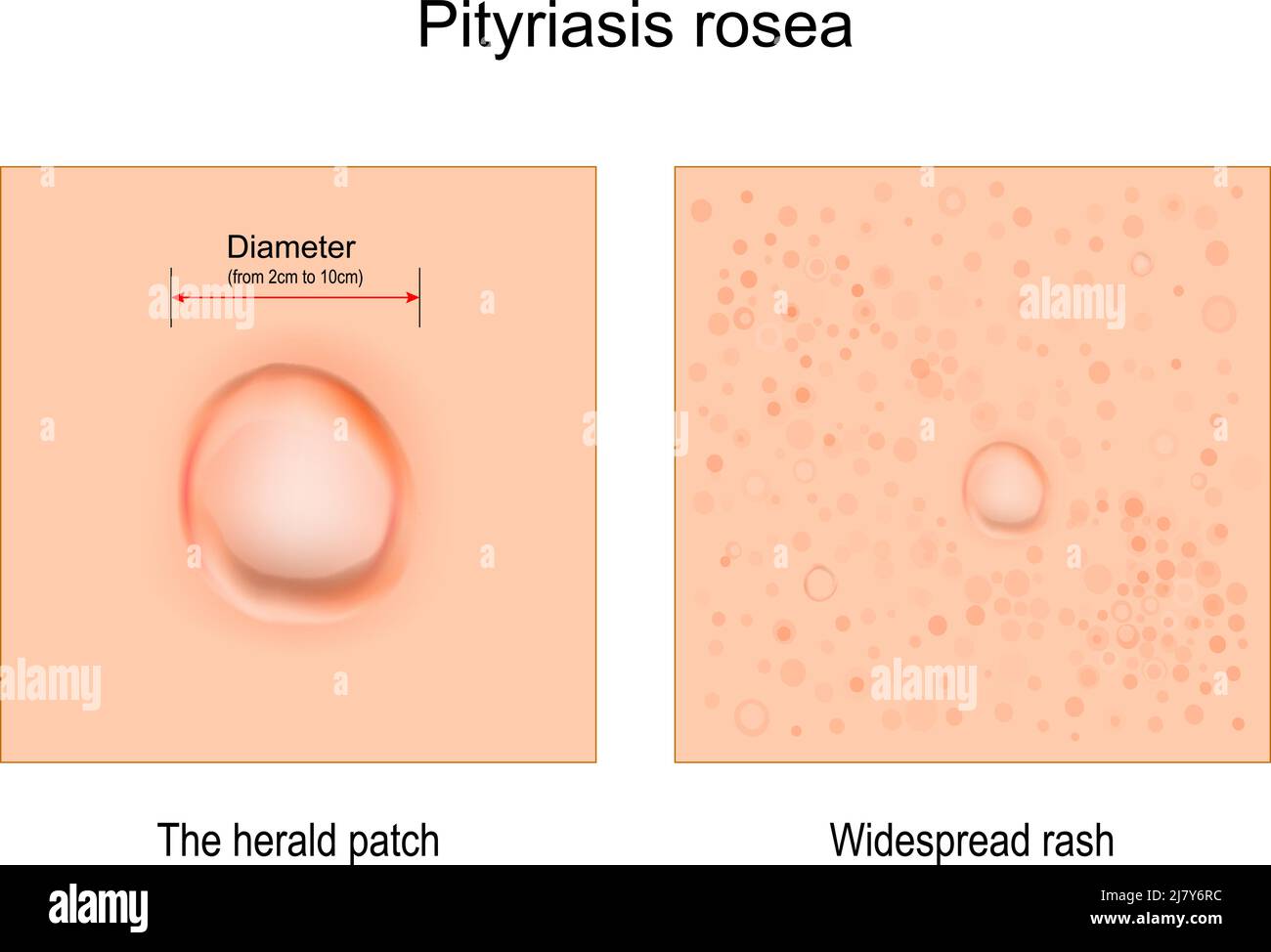Pityriasis rosea. Nahaufnahme von Hautausschlag. Anzeichen und Symptome. Der Herold Patch und weit verbreitete Ausschlag. vektor-Illustration Stock Vektor