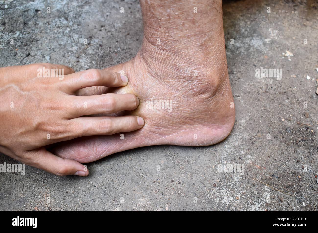 Lochfraß-Ödem der unteren Extremität. Geschwollenes Bein eines alten asiatischen Mannes. Stockfoto