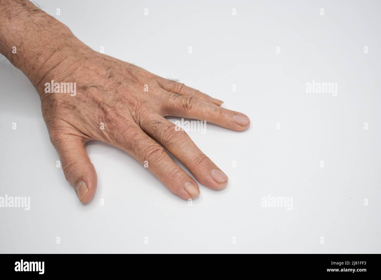 Spastische Hand. Spastizität der Handmuskulatur. Konzept der Handgesundheit. Stockfoto