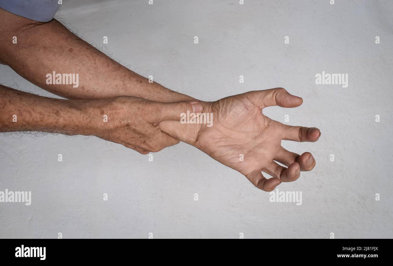 Volkmanns Kontraktur im linken oberen Teil des älteren Mannes aus Südostasien. Es ist eine dauerhafte Verkürzung der Unterarmmuskulatur, die zu einer klawlike führt Stockfoto