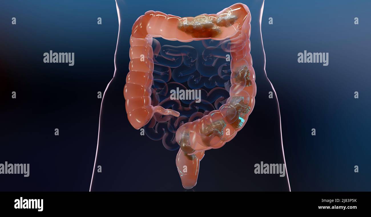 3D Darstellung der Anatomie des menschlichen Verdauungssystems, Darmerkrankungen, Abführmittel, Verstopfungsverhetzung, 3D Render Stockfoto