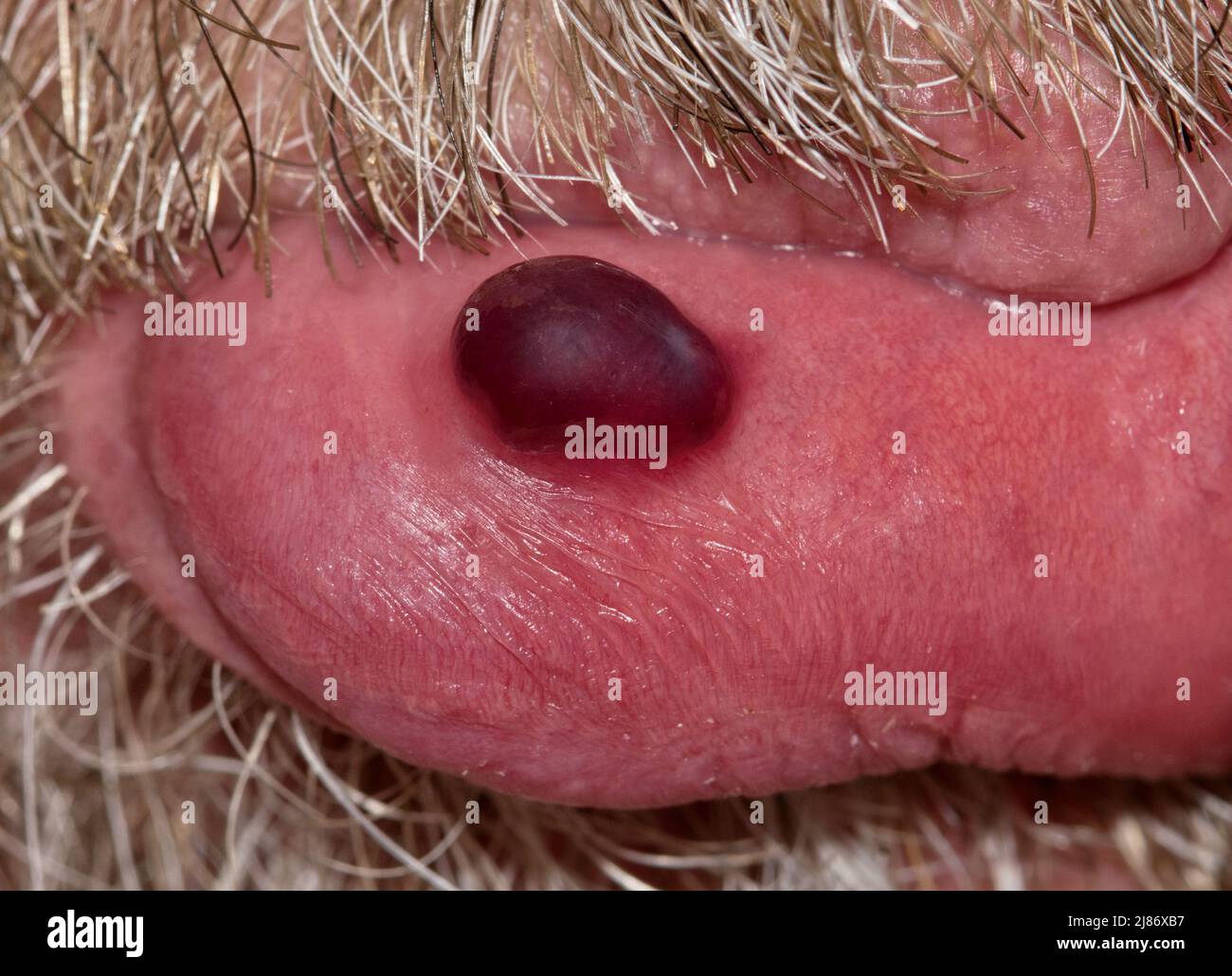 Blutblase isoliert auf der Unterlippe des kaukasischen Männchens, umrahmt mit Schnurrbart und Bart. Häufig verursacht durch Stress oder Beißen von Lippen. Stockfoto