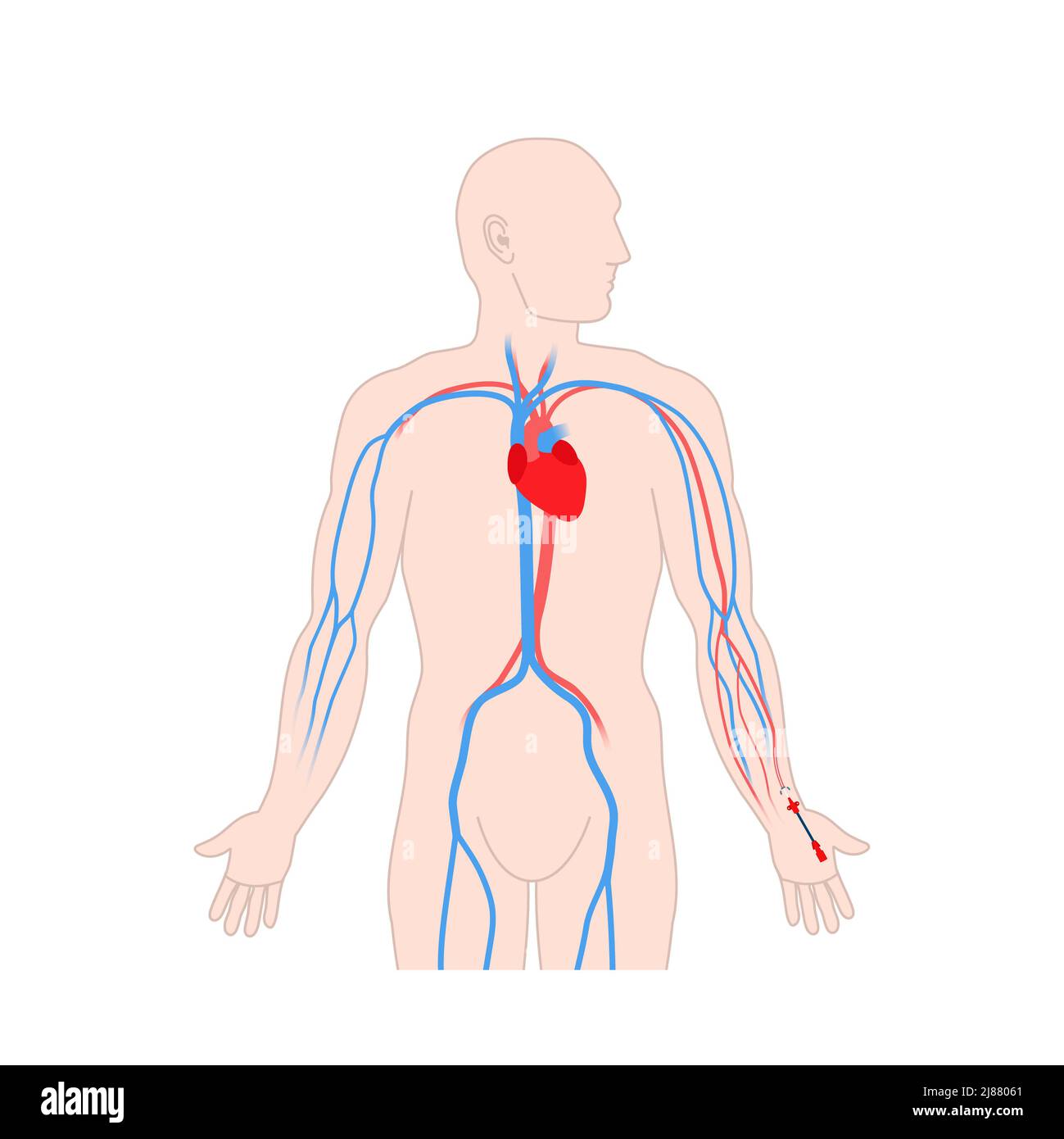Arterienkatheter, Abbildung Stockfoto