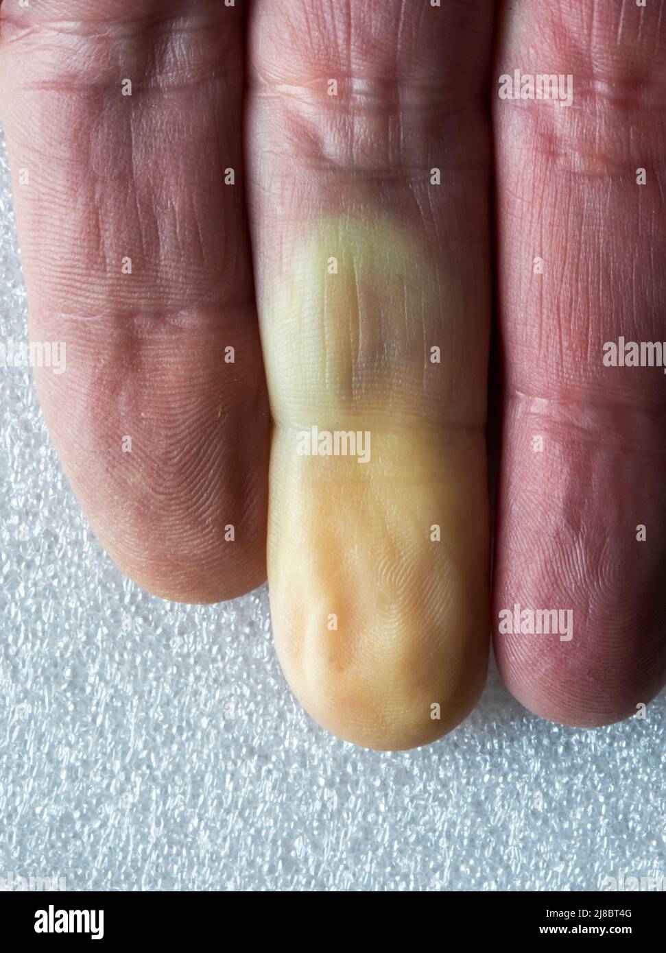 BIOLOGIE, MEDIZIN, KRANKHEIT, RaynaudsKrankheit. Der Blutfluss nimmt in den Arterien ab und