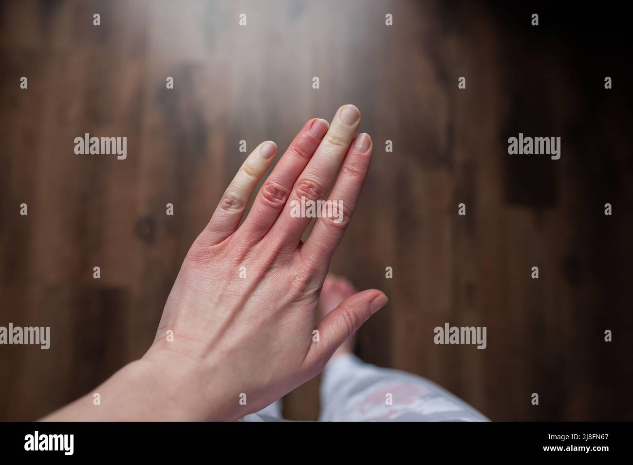 Hand einer Person mit Raynaud-Phänomen während des Angriffs mit einigen weißen Fingern, Hautfarbveränderungen Raynaud-Syndrom Raynaud-Syndrom Stockfoto
