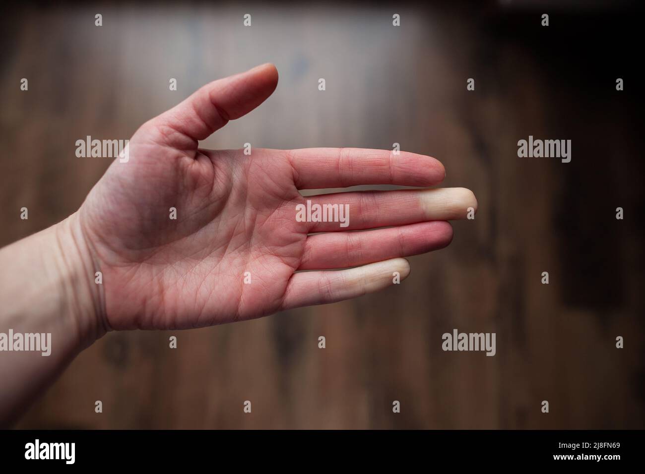 Hand einer Person mit Raynaud-Phänomen während eines Angriffs mit einigen weißen Fingern, Farbänderung Raynaud-Syndrom Raynaud-Syndrom Stockfoto