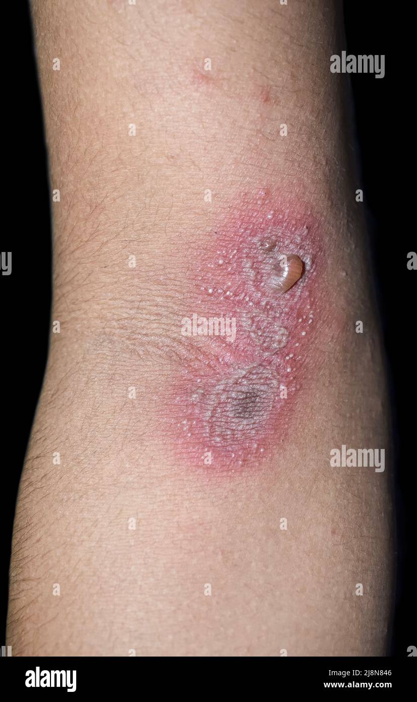 Paederus Dermatitis im Arm. Es handelt sich um einen merkwürdigen, reizenden Kontakt, der durch einen Käfer der Gattung Paederus verursacht wird. Stockfoto