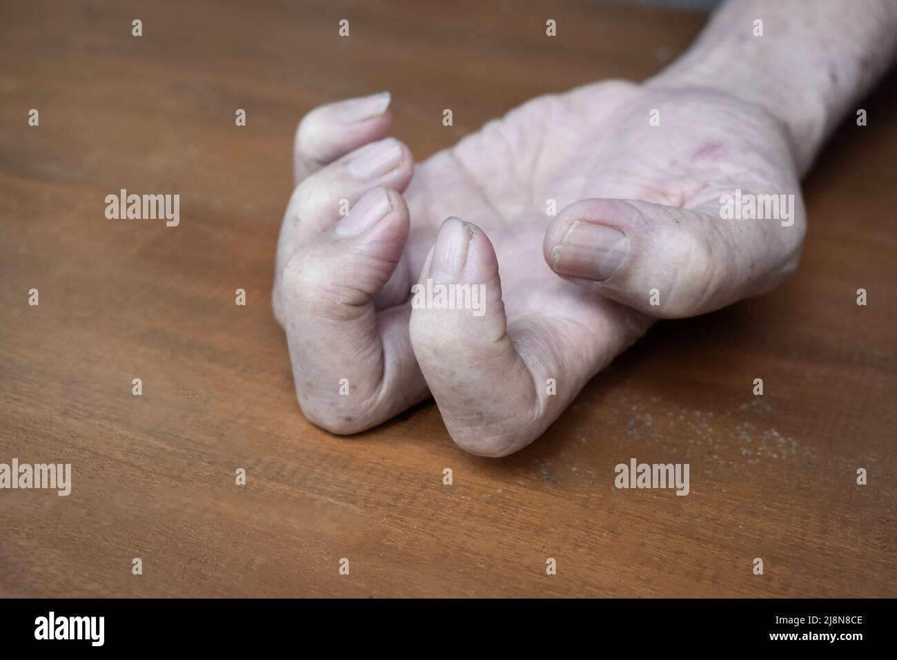 Volkmann Kontraktur im linken oberen Teil des älteren Mannes aus Südostasien. Es ist eine dauerhafte Verkürzung der Unterarmmuskulatur, die zu einem klawähnlichen Po führt Stockfoto
