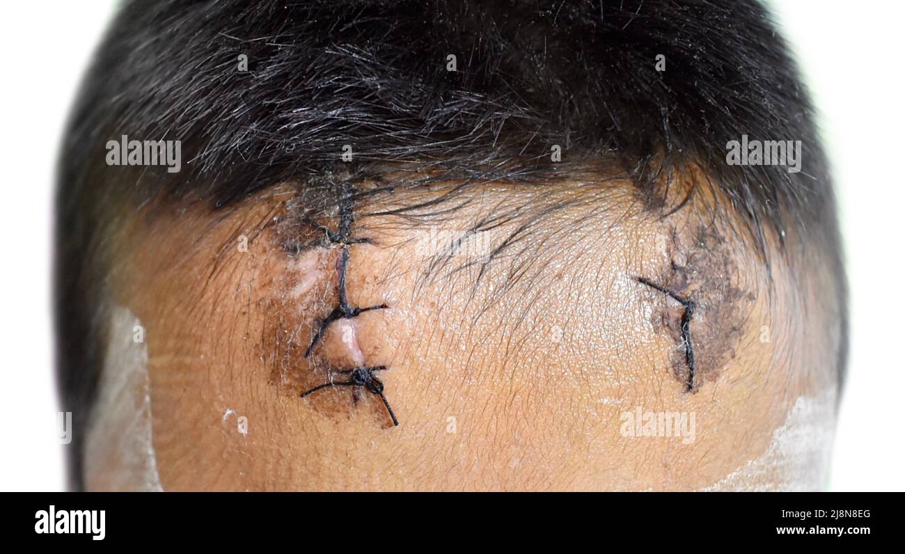 Kleine vernähte Wunden, die von Schorf und leichter Cellulitis in der Stirn des südostasiatischen, myanmarischen Kindes umgeben sind, fast verheilt sind. Stockfoto