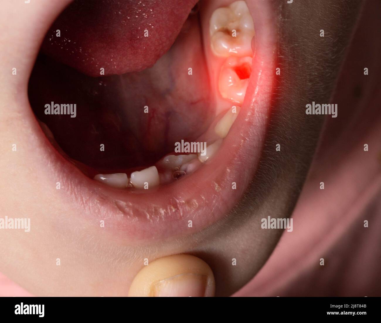 Tiefes Karies bei Kindern auf Milchzähnen. Behandlung von Karies, Zahnschmerzen. Makro Stockfoto