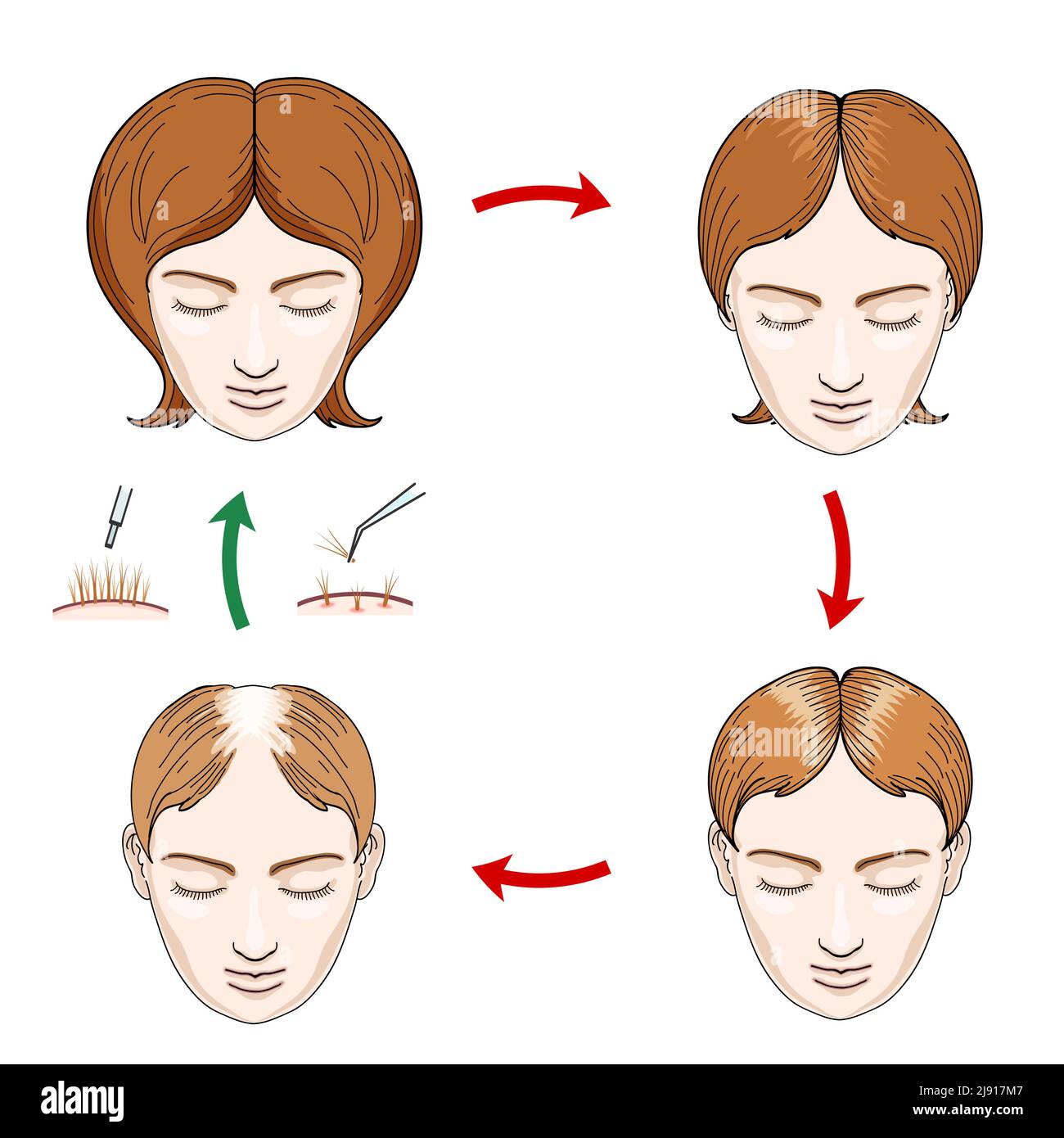 Symbole für weiblichen Haarausfall und Haartransplantation. Haarausfall Frau, Pflege Haar, Kopf weiblich, Kopfhaut Mensch, Wachstum Haar, vektorgrafik Stock Vektor