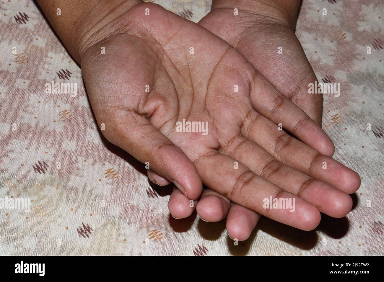 Ein Bein Baby zur Pflege zur Hand Stockfoto