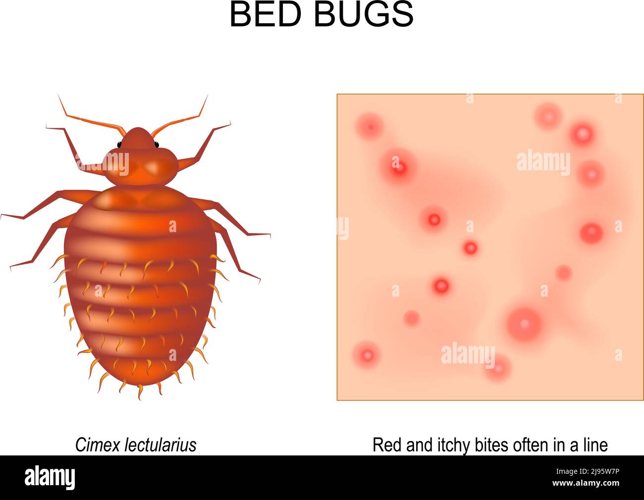 Bettwanzen. Erwachsenes Weibchen von Cimex lectularius. Nahaufnahme der Haut mit roten und juckenden Bissen, die oft in einer Linie liegen. Vergrößerung eines Insekts. Draufsicht Stock Vektor