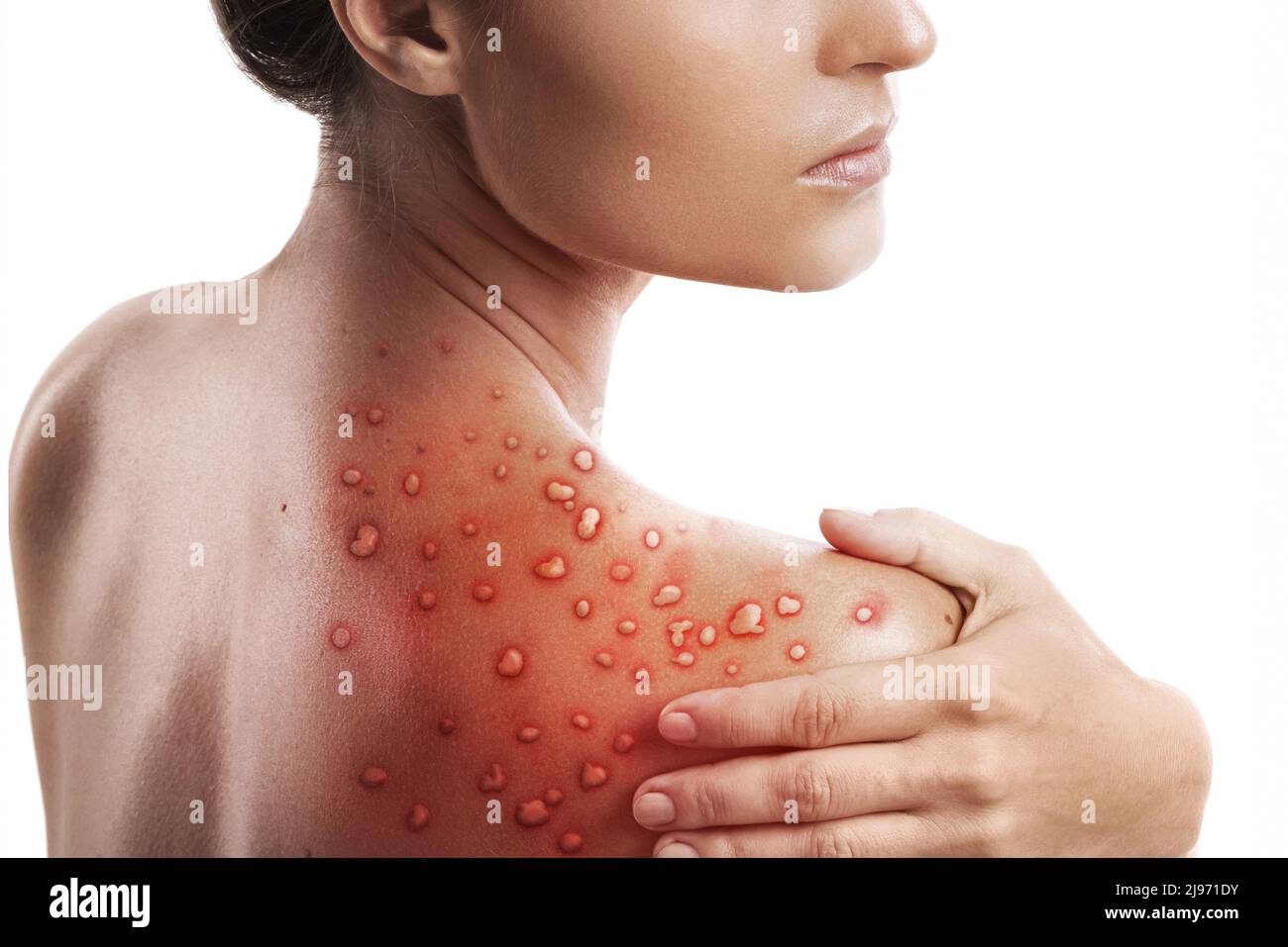Frau und ihre Haut sind von Blasenausschlag aufgrund von Monkeypox auf weißem Hintergrund betroffen Stockfoto