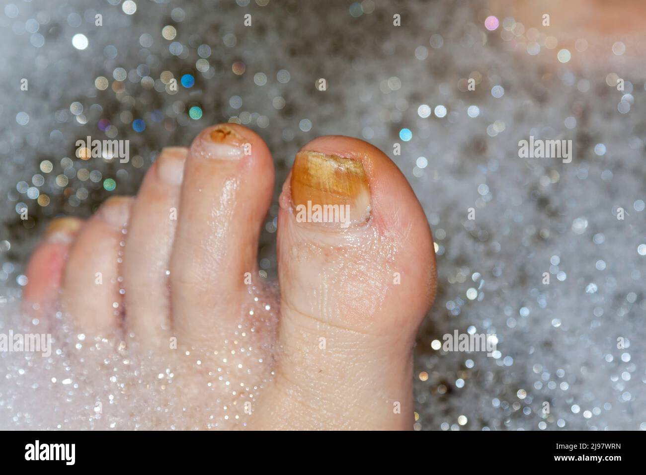Diabetischer fuss -Fotos und -Bildmaterial in hoher Auflösung – Alamy