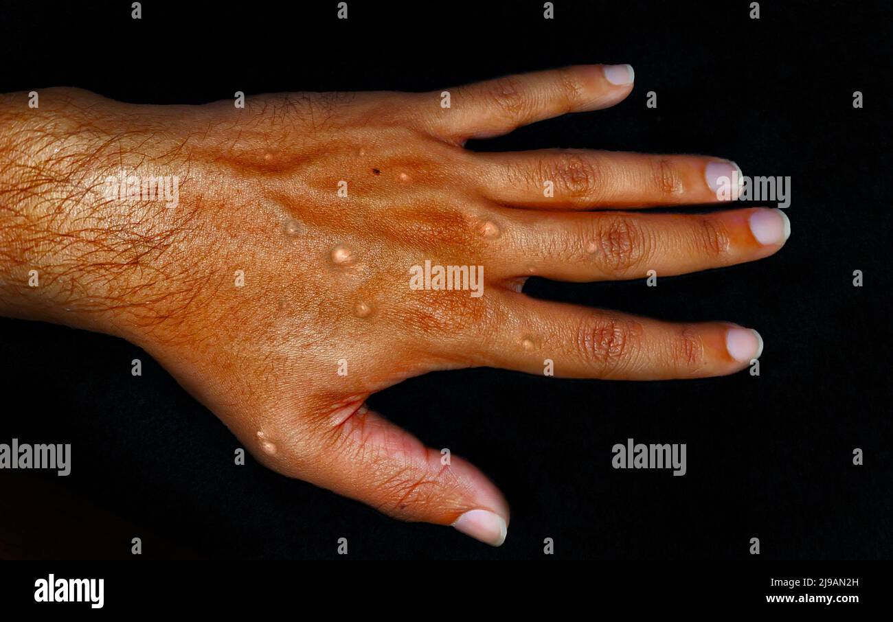 Monkeypox-Infektion mit einem akuten Ausschlag mit kleinen, mit Flüssigkeit gefüllten Blasen. Monkeypox ist eine virale Zoonose, Symptome ähnlich wie Pocken. Stockfoto