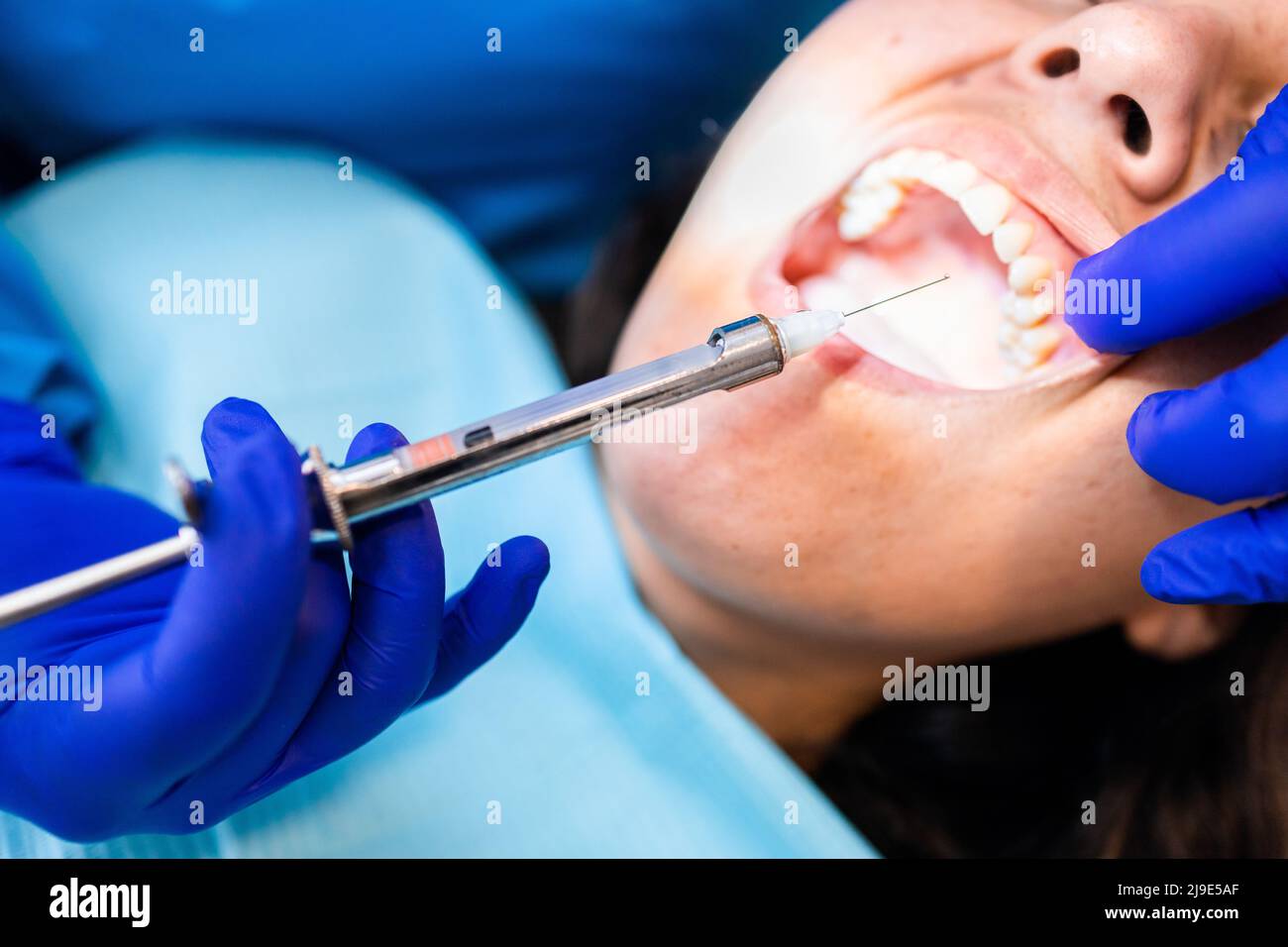 Die Hände des Zahnarztes, die ihre Patientin mit einer Spritze in Zahnanästhesie betäubt. Selektiver Fokus. Stockfoto