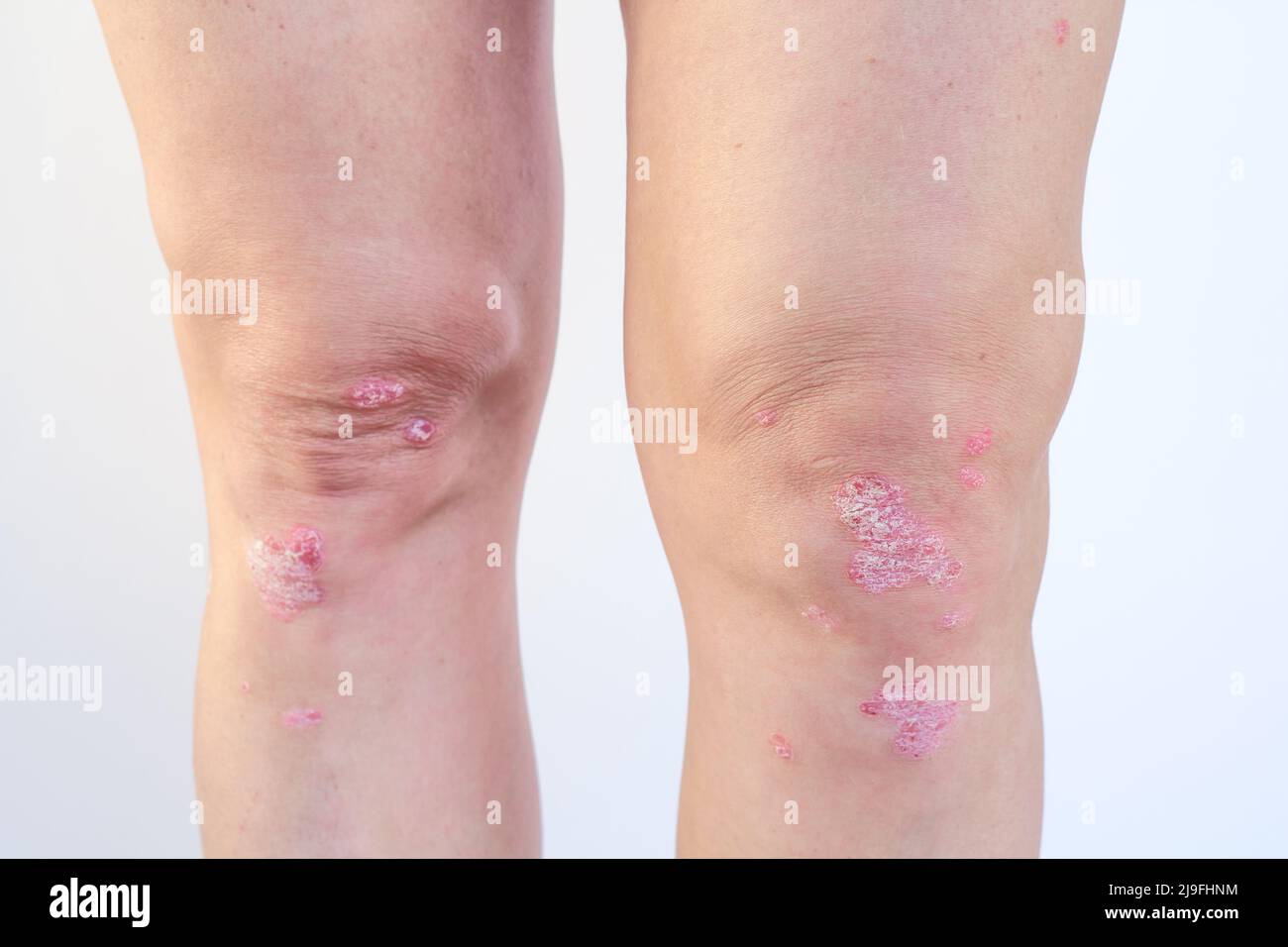 Kniegelenkerguss (Wasser auf dem Knie). Akute psoriatische Arthritis, Arthrose, Meniskusverletzung. Überschüssige Synovialflüssigkeit im und um das linke Kniegelenk Stockfoto