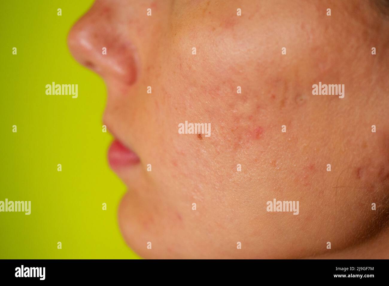 Post-Akne, Narben und rote eiternde Pickel im Gesicht einer jungen Frau. Konzept von Hautproblemen und harmonischem Versagen Stockfoto