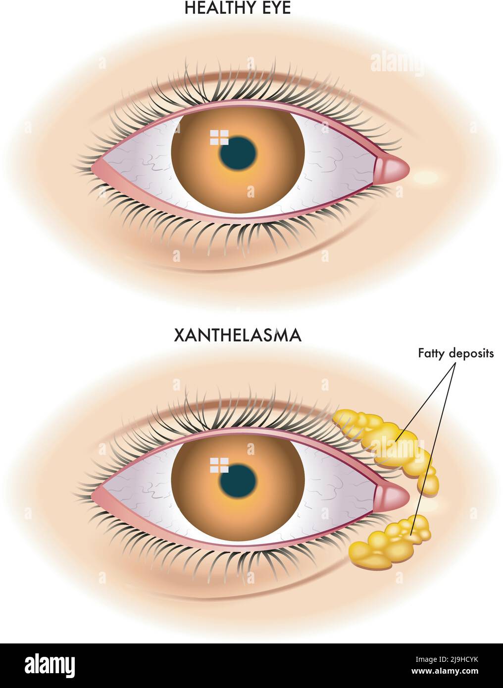 Die medizinische Abbildung zeigt den Vergleich zwischen einem normalen Auge und einem von Xanthelasma betroffenen Auge. Stock Vektor