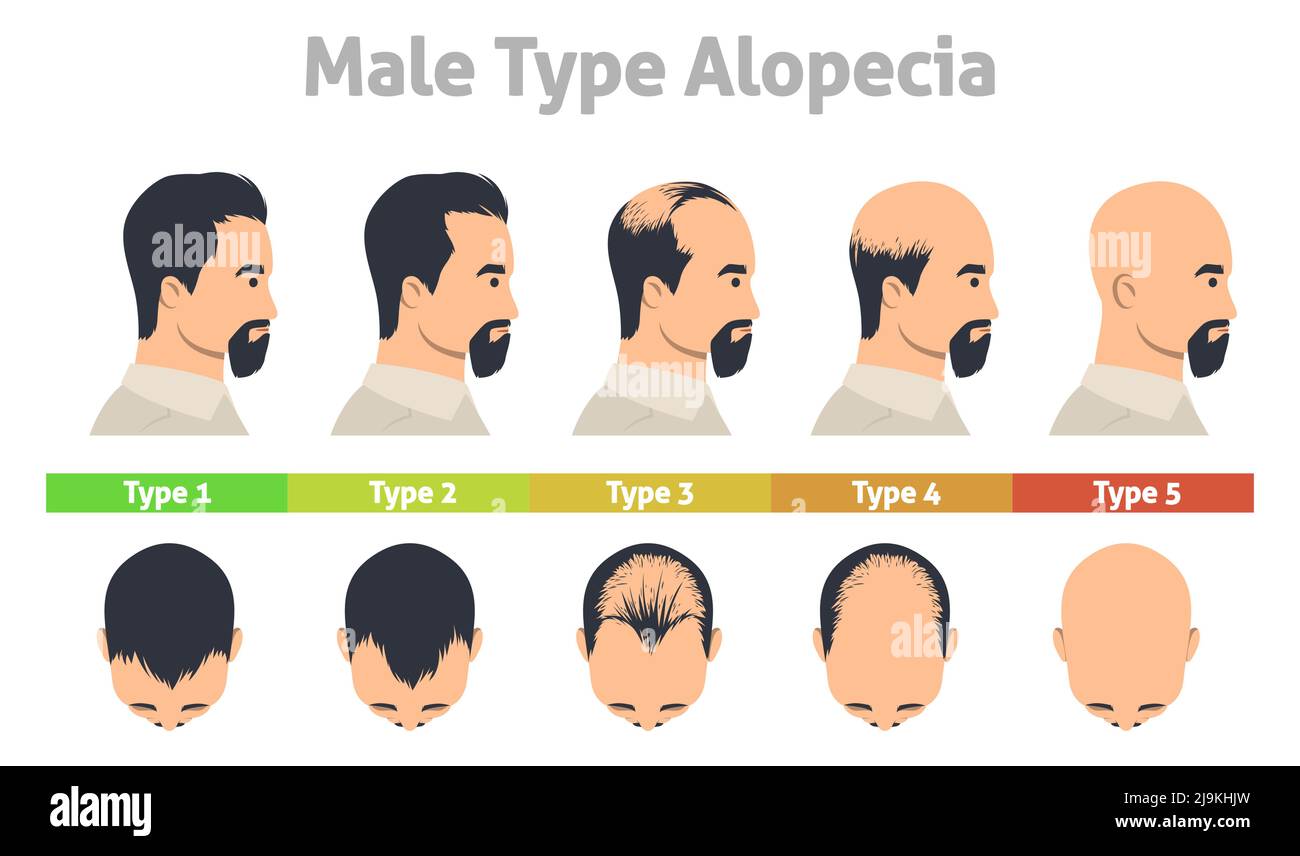 Männliche Art Alopezie Poster Haarausfall Stadium Stock Vektor