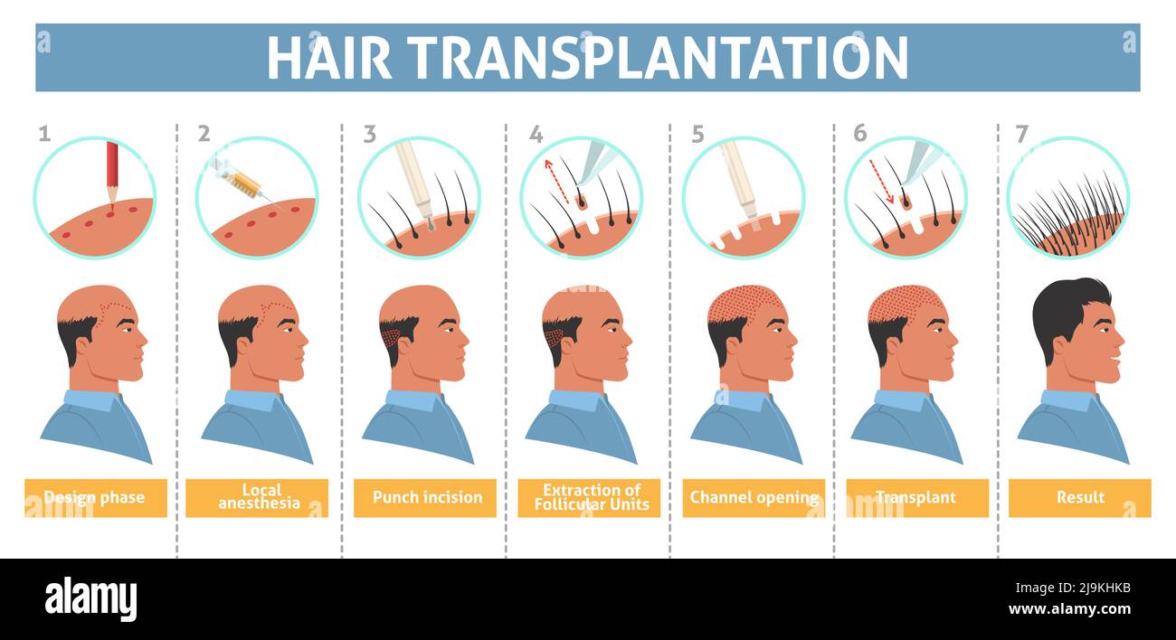 Poster mit Schritt-Info-Poster zur Haartransplantation bei Männern Stock Vektor