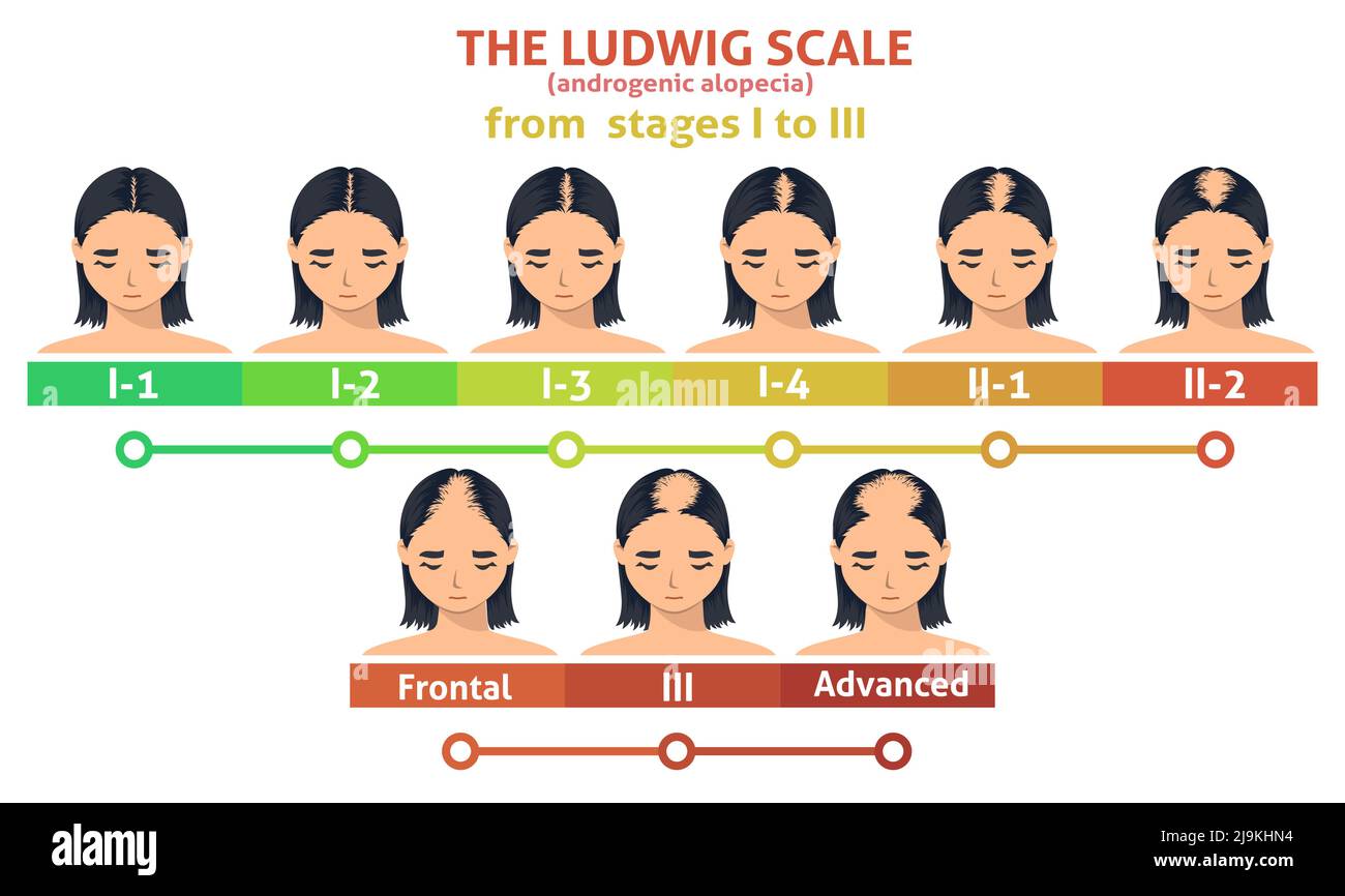 Ludwig-Skala von androgener Alopezie-Schritt-Poster Stock Vektor