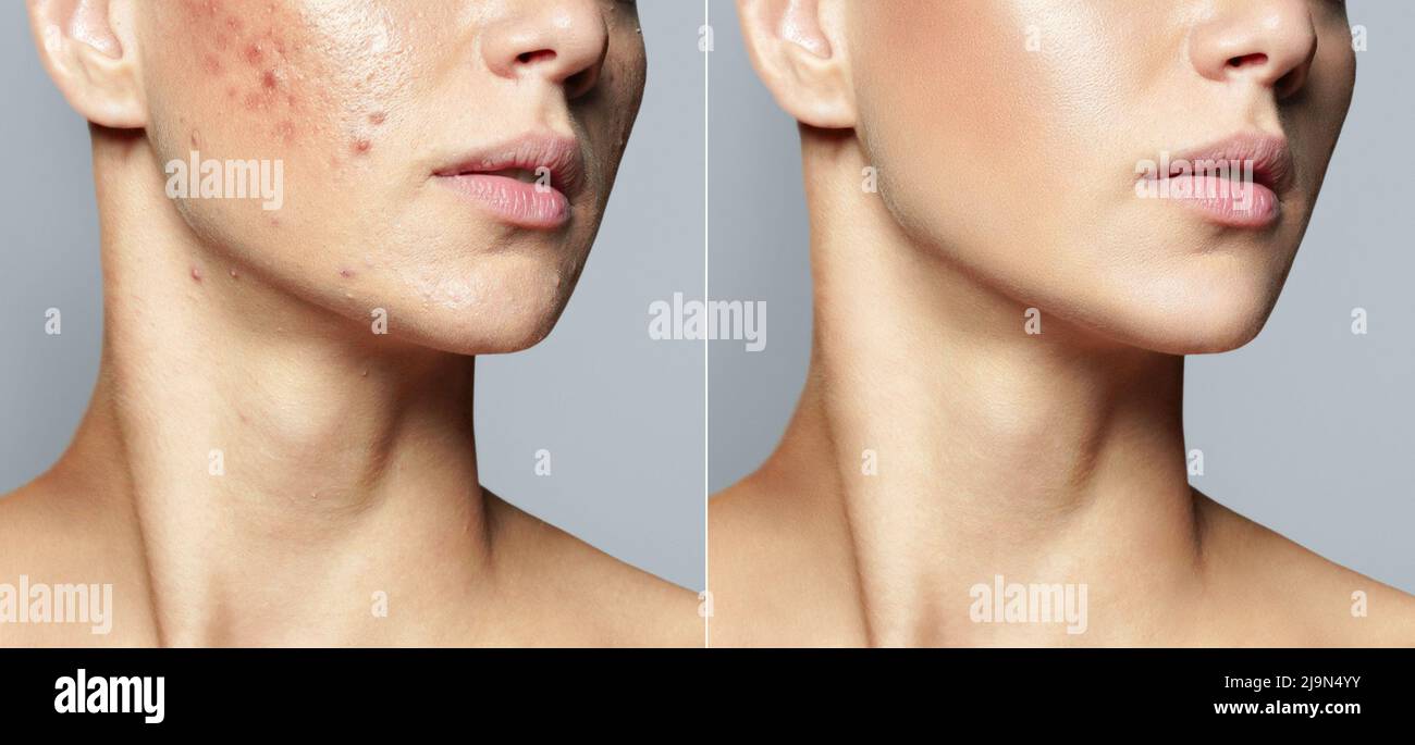 Teenager-Mädchen vor und nach Akne-Behandlung Hautpflege Konzept. Akne-Behandlung in einer Kosmetologie-Klinik Stockfoto