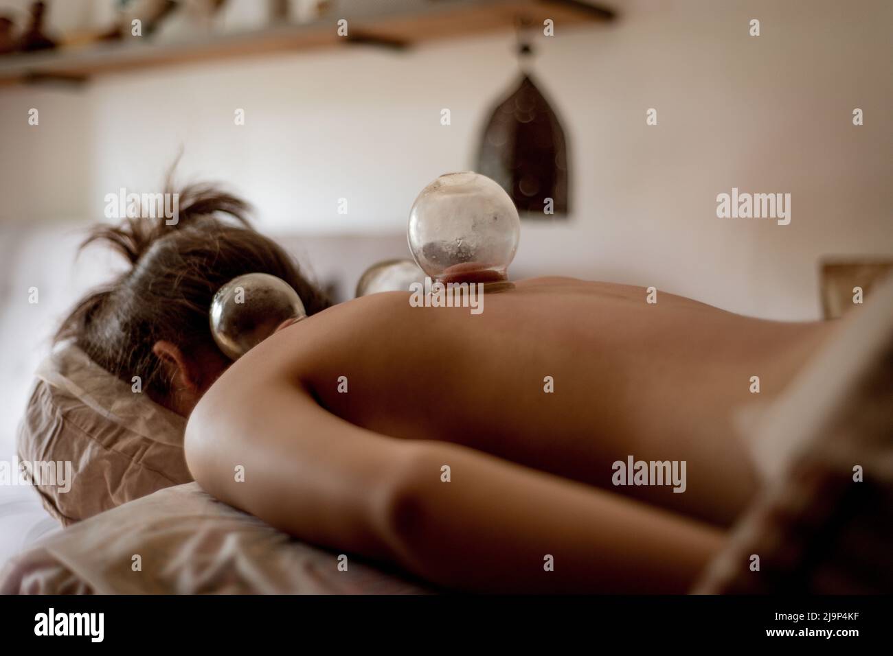 Entspannte junge Frau, die auf dem Rücken eine Schröpfbehandlung erhält, traditionelle chinesische Medizin. Stockfoto