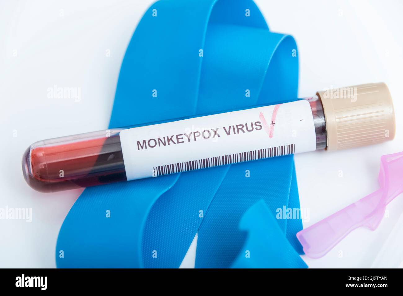 Blutprobenschlauch für Monkeypox-Virus-Test. Stockfoto