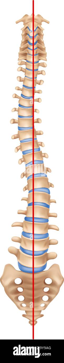 Anatomie der menschlichen Wirbelsäule – Skoliose-Komposition mit isoliertem Bild der gekrümmten Wirbelsäule mit Knochen und gerader Vektordarstellung Stock Vektor
