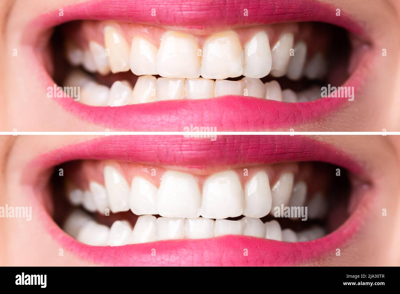 Close-up mit einem lächelnden Frau, die Zähne vor und nach dem Bleichen Stockfoto