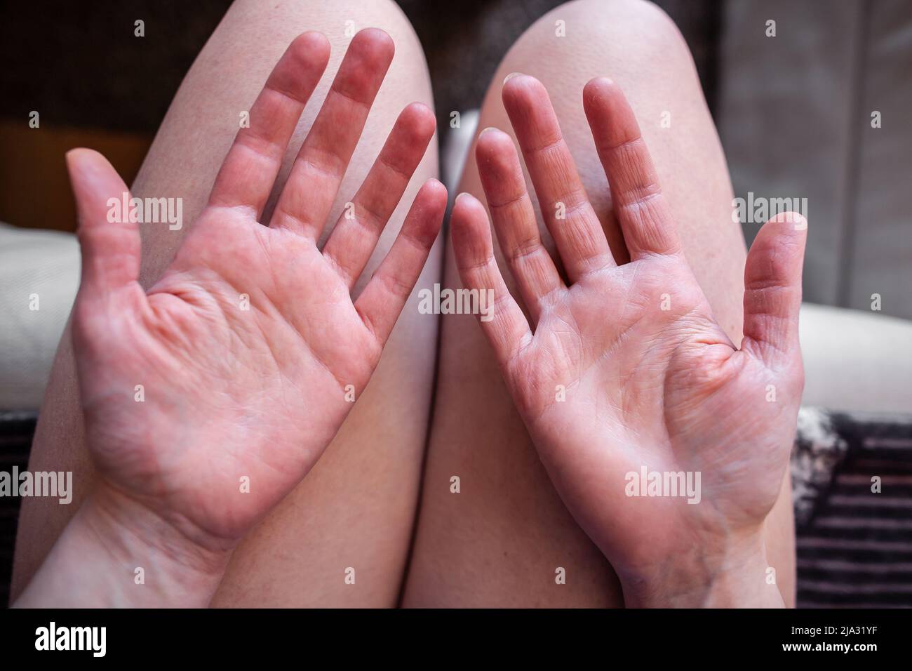 Hände einer jungen Frau mit Ehlers-Danlos- und Raynaud-Syndrom, mit sehr trockener, alt aussehender Haut, EDS-Haut zerknittert, ohne in einer Wassernaht zu sein Stockfoto