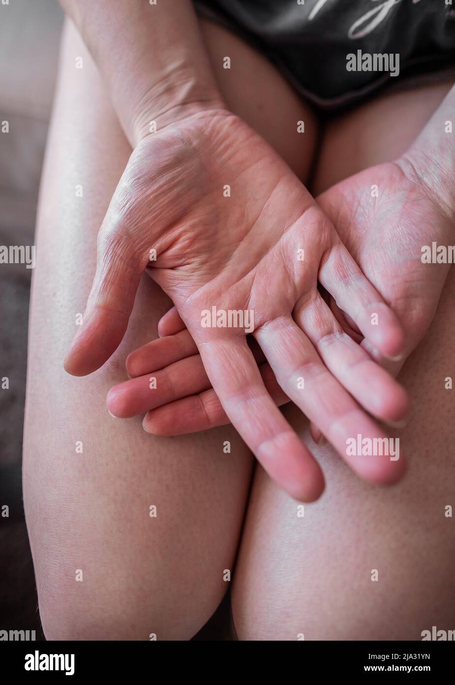 Hände einer jungen Frau mit Ehlers-Danlos-Syndrom auf den Knien, mit sehr trockener, enger Haut, EDS-Haut zerknittert, ohne im Wasser zu sein Stockfoto