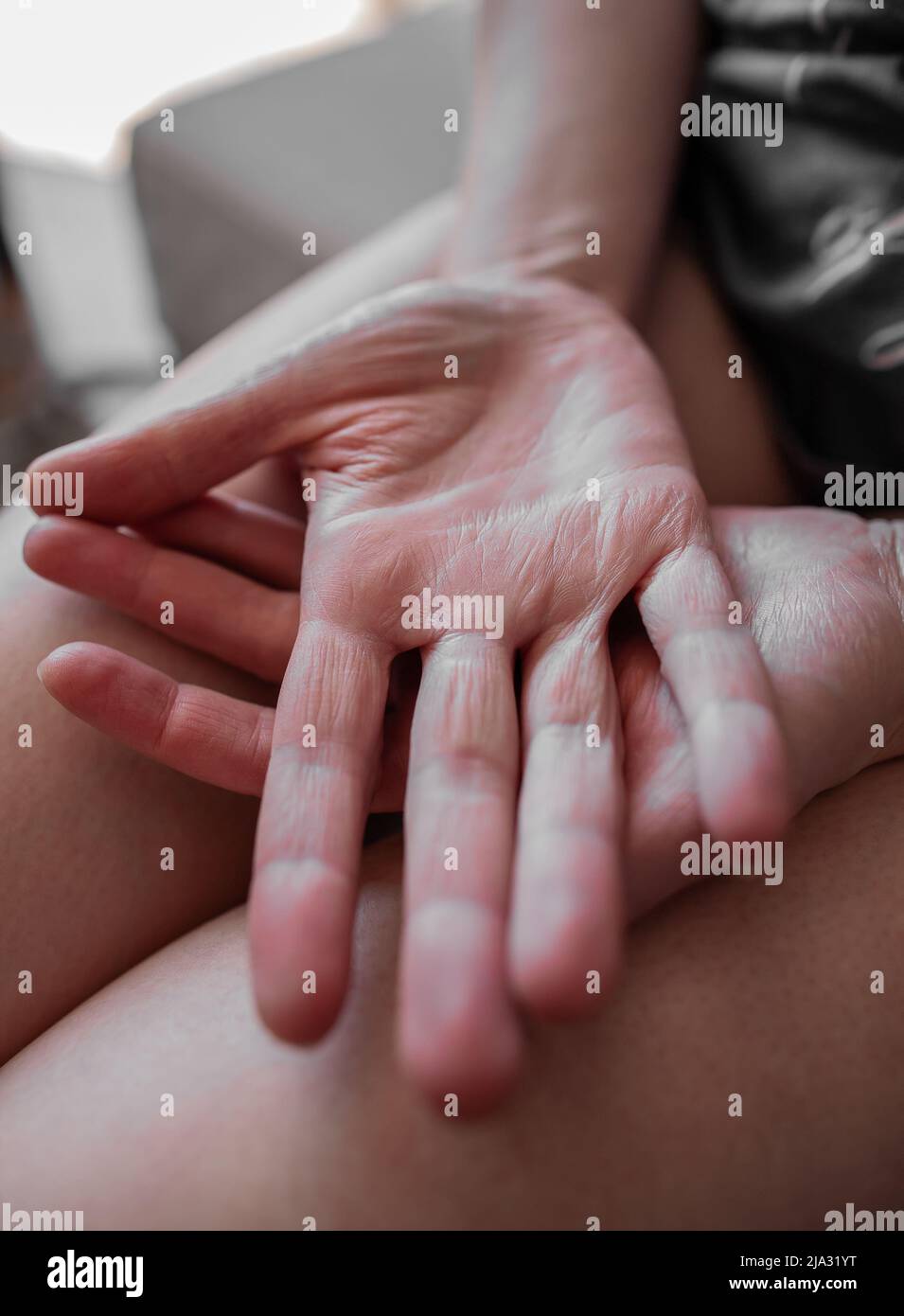 Hände einer jungen Frau mit Ehlers-Danlos-Syndrom, mit sehr trockener, alt aussehender Haut, EDS-verknitterter Haut, die vorzeitig alt aussieht Stockfoto