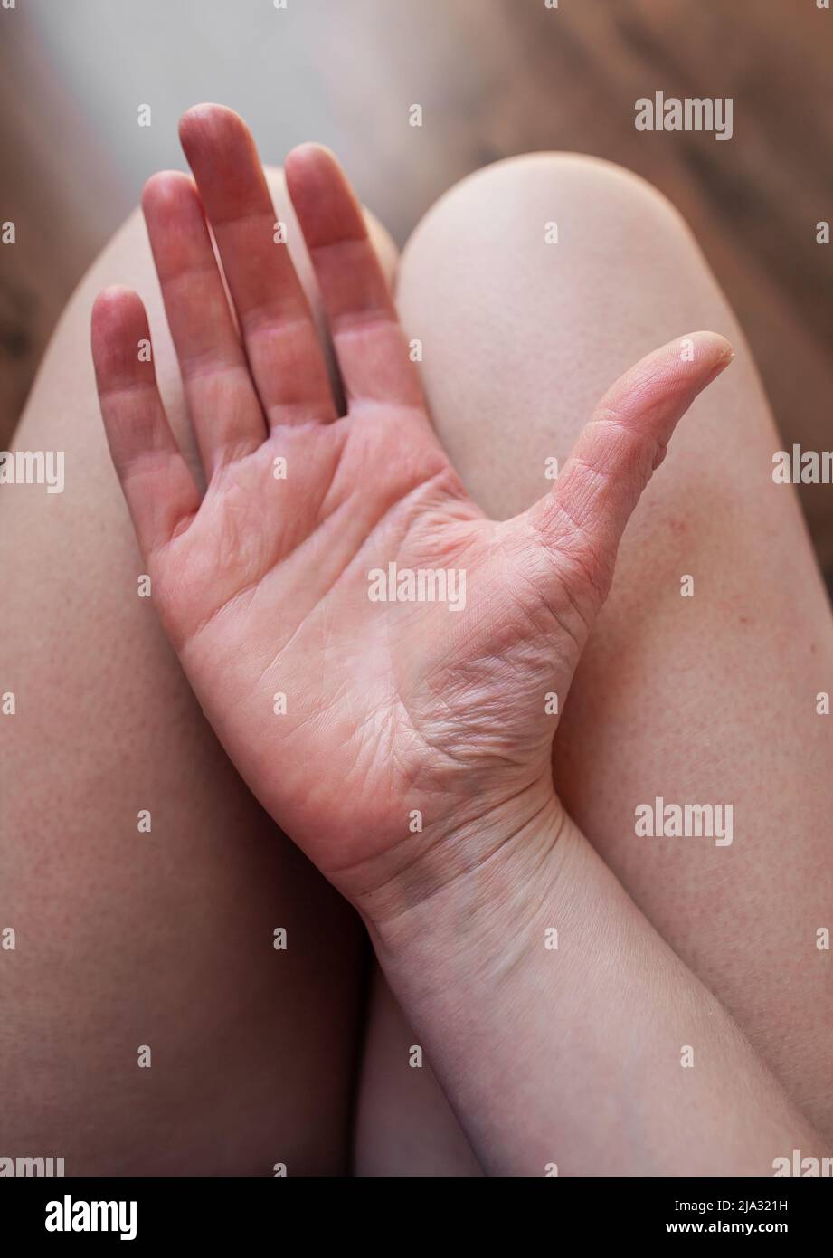 Hand einer jungen Frau mit Ehlers-Danlos-Syndrom auf den Knien, mit sehr trockener, enger Haut, EDS-Haut zerknittert, ohne im Wasser zu sein Stockfoto
