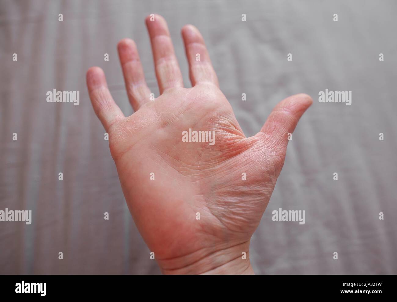 Hand einer Person mit Ehlers-Danlos-Syndrom, mit trockener, dehnbarer, altaussehender Haut, EDS-verknitterter Haut Stockfoto