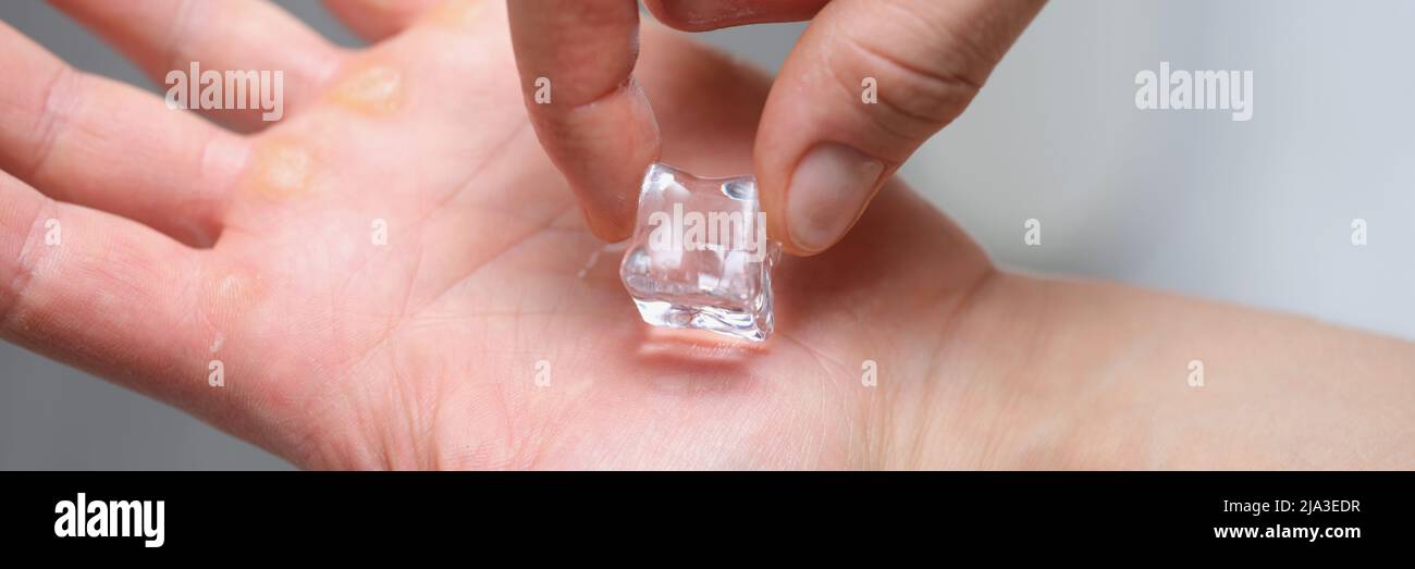 Ein Stück Eis auf der Handfläche eines Mannes, Schwielen auf seinen Händen Stockfoto