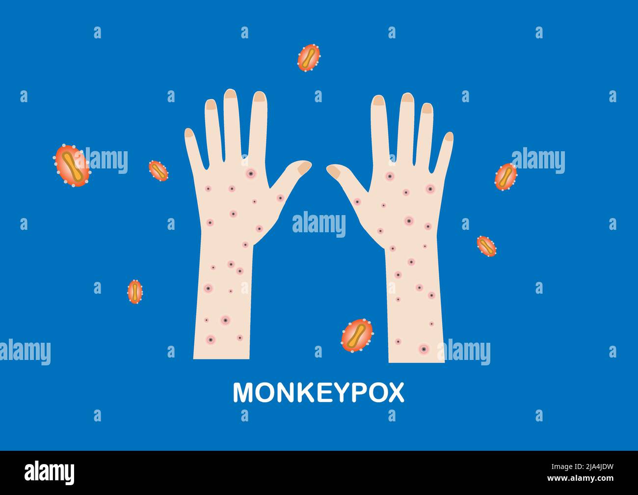 Illustration von Hautläsionen oder Ausschlägen an den Händen des Patienten und Monkeypox-Viren Stock Vektor