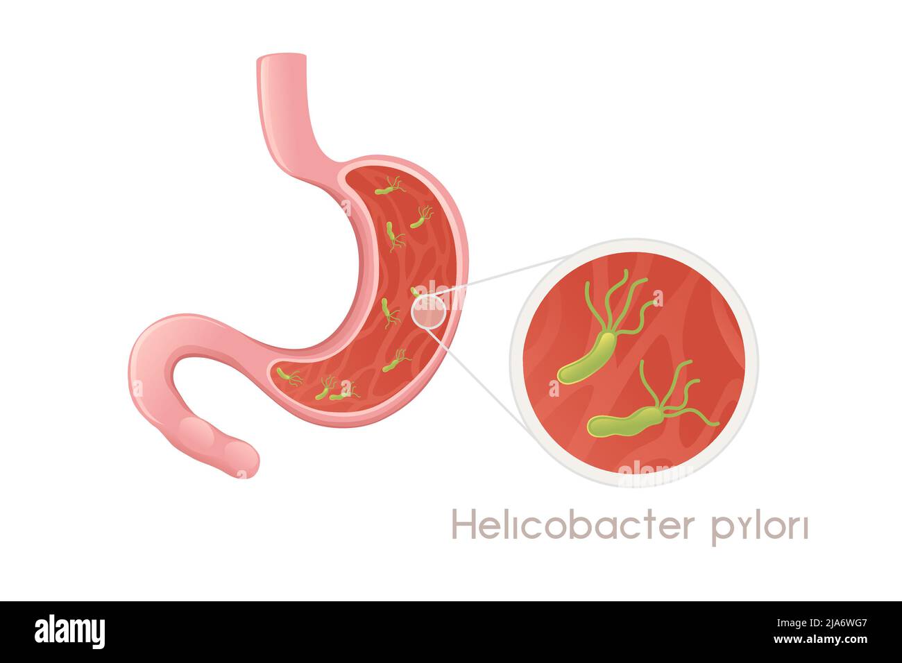 Menschlicher Magen mit Helicobacter pylori Cartoon Design menschliche Anatomie Organ Vektor Illustration auf weißem Hintergrund Stock Vektor
